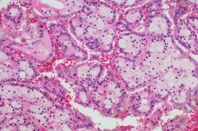 Detail of renal cells related to molecular glue degradation