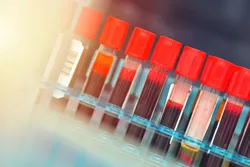 Clinical mass spectrometry samples in test tubes